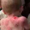 bites