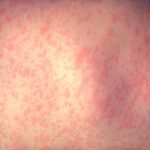 measles-virus