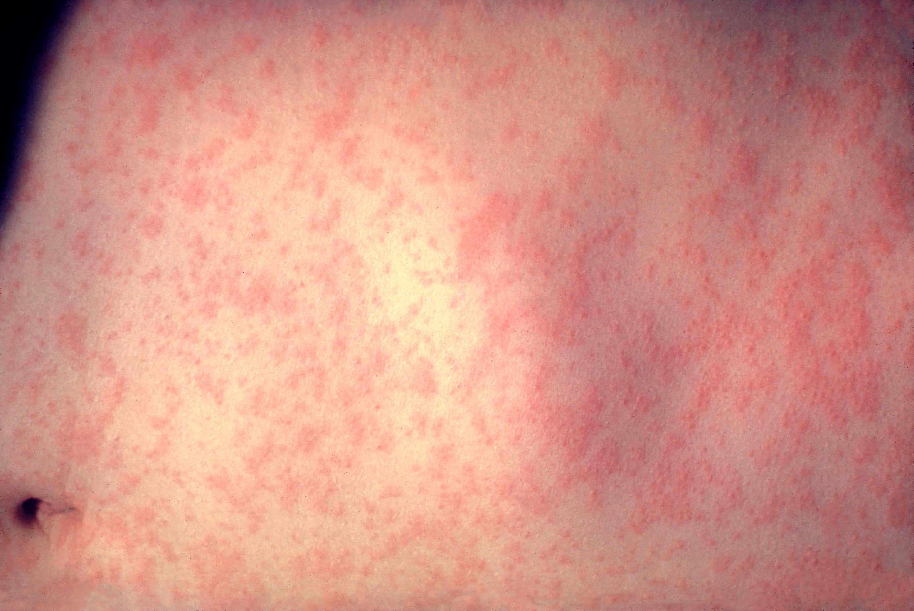 measles-virus