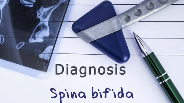 istock_030519_spinabifida