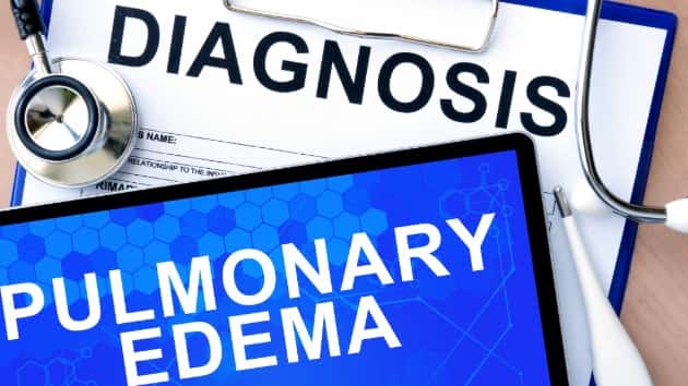 istock_6719_pulmonaryedema