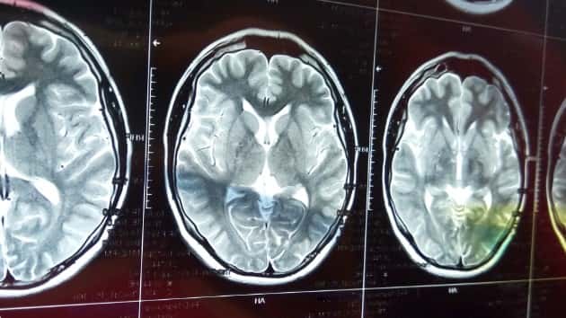istock_11419_brainmri