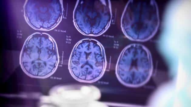 istock_110519_alzheimersdrug
