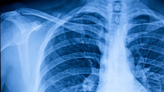 istock_82120_lungxray