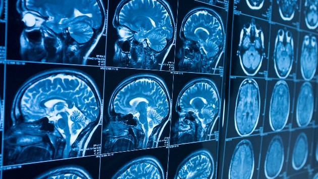 istock_11221_brainscans