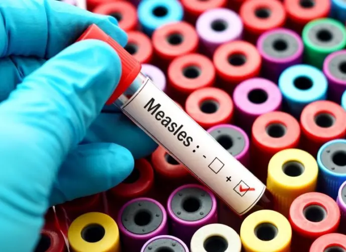 positive Measles vile /test. shows colorful vials in background