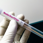 measles-test-150x150114822-1