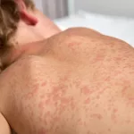 close up of the back of a child laying down in bed with the measles rash on his back