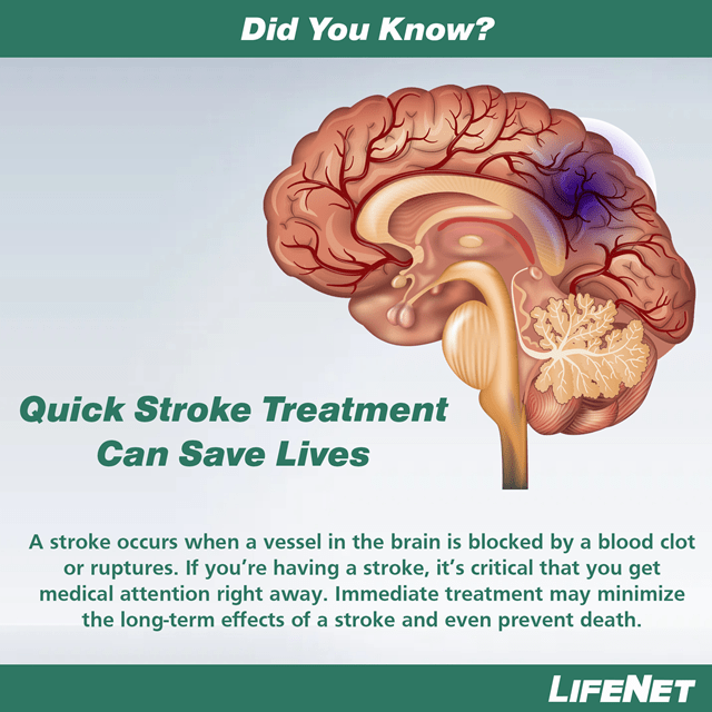 stroke_brain-png-3