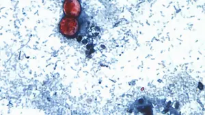 cyclospora-outbreak-history