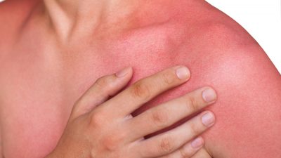 Texas Mom Shares Old Family Secret To Get Rid Of Sunburn In 30 Minutes. Get the trick here