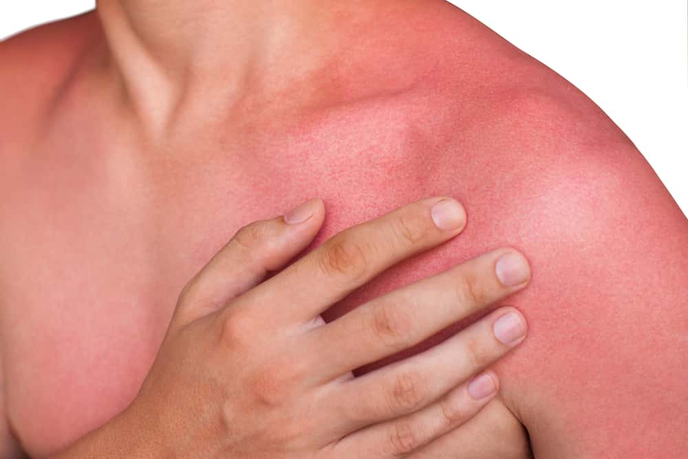 Texas Mom Shares Old Family Secret To Get Rid Of Sunburn In 30 Minutes. Get the trick here