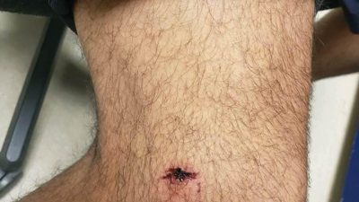 Austin police officer bitten by a homeless man