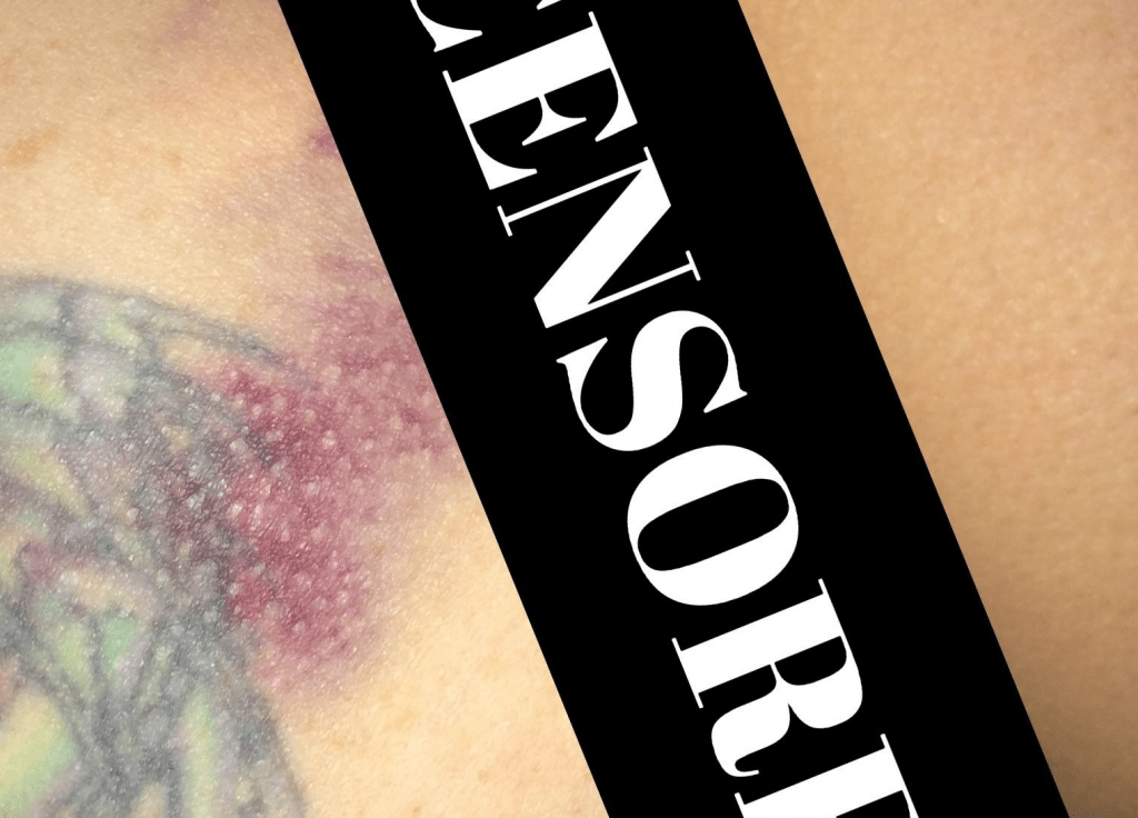 Cropped Image of Deb's bruised bum.