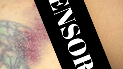 Cropped Image of Deb's bruised bum.