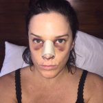 Keep Bruisin' Bruisin' Bruisin'