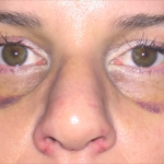 Still Bruised Without The Splint