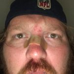 Jason Caught A Softball With His Face: jason after a softball hit his face