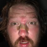 Jason Caught A Softball With His Face: Jason After A Softball Hit His Face