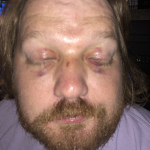 Friday: Updated Photo of Jason's Butterfly Black Eyes : Updated Photo of Jason's Butterfly Black Eyes 