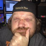 Updated Photo of Jason's Black Eyes : Second day of Jason's black eyes after getting hit by a softball 