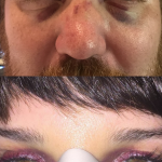 Jason and Deb Black Eyes : side by side comparison of Jason and Deb's black eyes