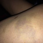 deb-bruise