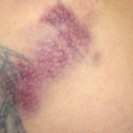 deb-butt-bruise