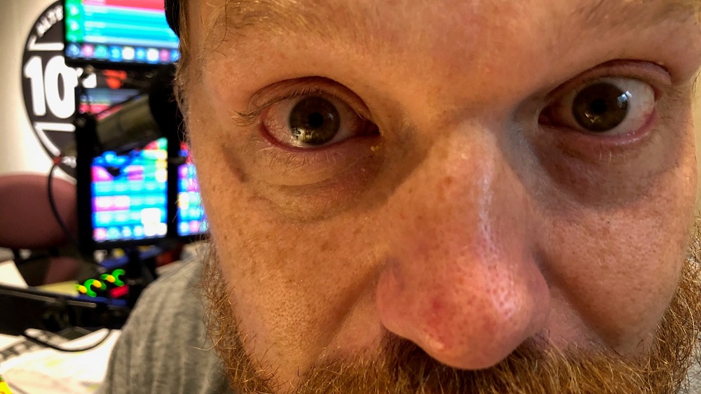 close up of jason's red and itchy eye