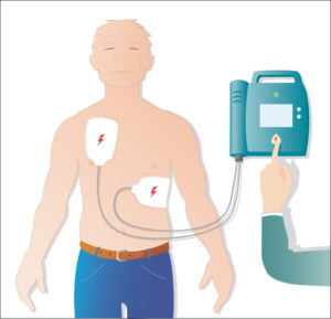 The Automated Defibrillator Enables The Cardiopulmonary Resuscitation During An Infarction. Its Simplicity Of Use And Its Automatization Analysis Of The Heart Beat, Delivery Of An Electric Shock Enabling It To Be Used By Anyone Not Being A Doctor..