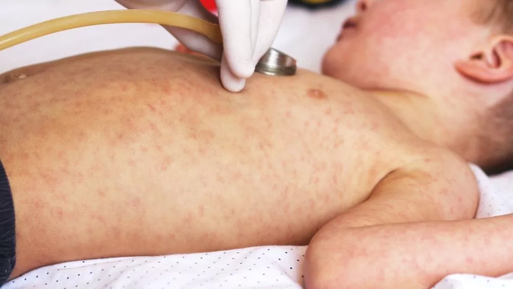 Viral disease. Measles rash. Concept doctor and patient. Child with viral infection measles and doctor with stethoscope