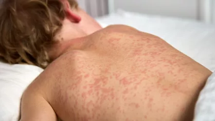 close up of the back of a child laying down in bed with the measles rash on his back