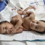 id5738768-conjoined_twins_separated_24283780619428-600x400153661-1