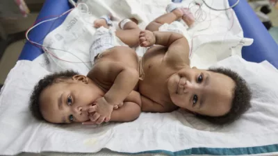 id5738768-conjoined_twins_separated_24283780619428-600x400153661-1