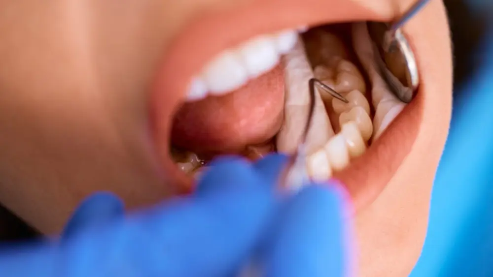 Dental Fillings