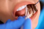 Dental Fillings