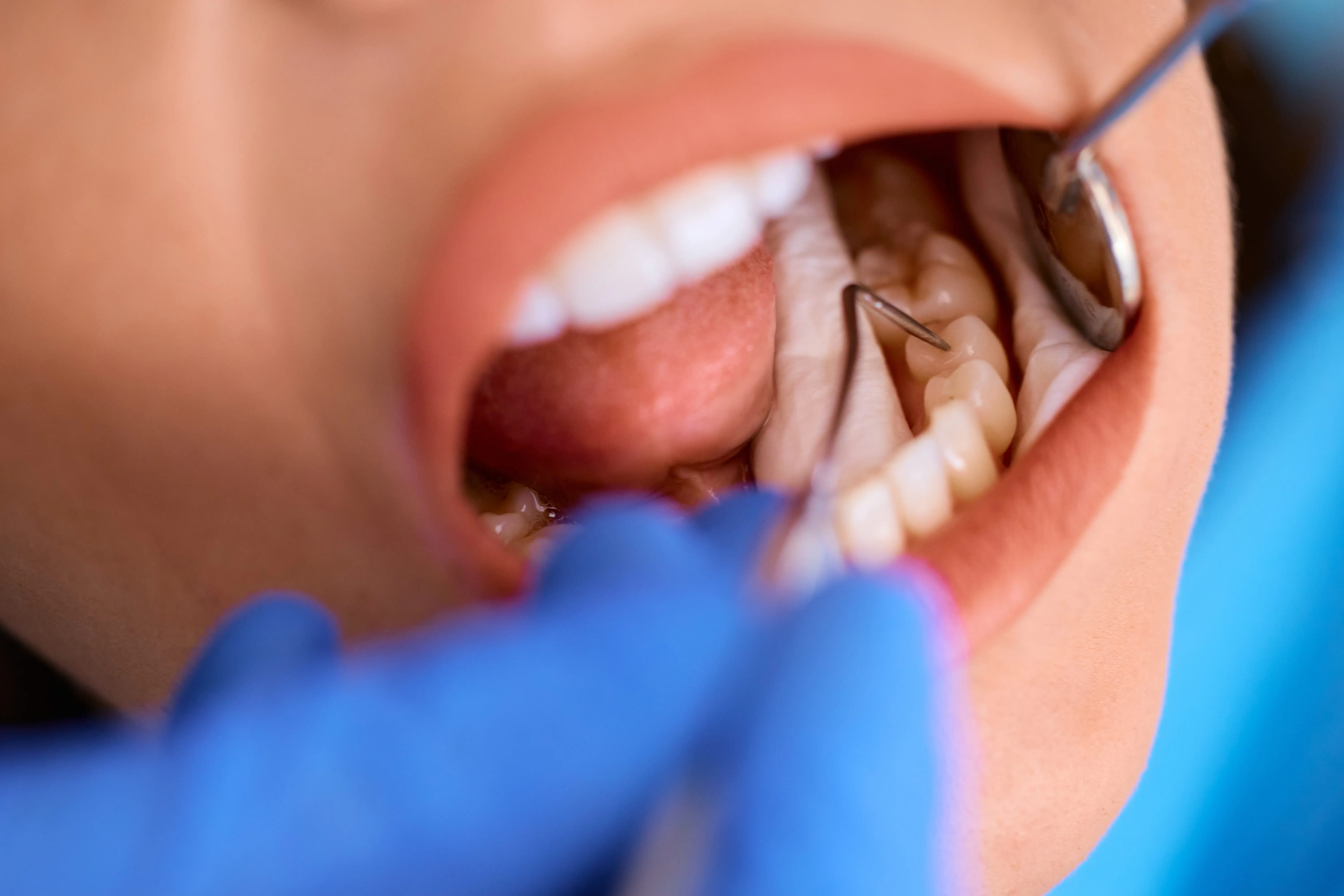 Dental Fillings