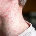measles