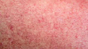 measles-jpeg