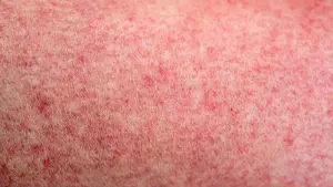 measles-jpeg-2