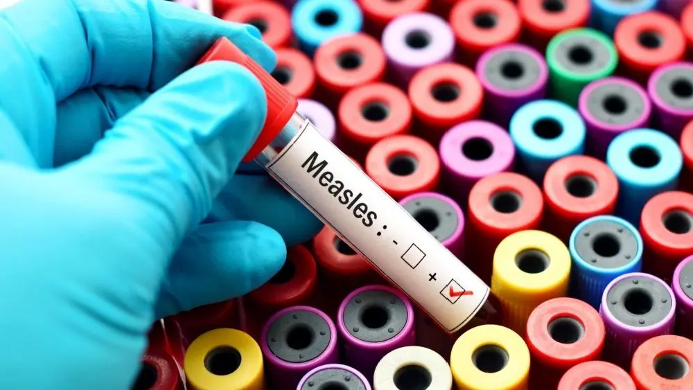 positive Measles vile /test. shows colorful vials in background