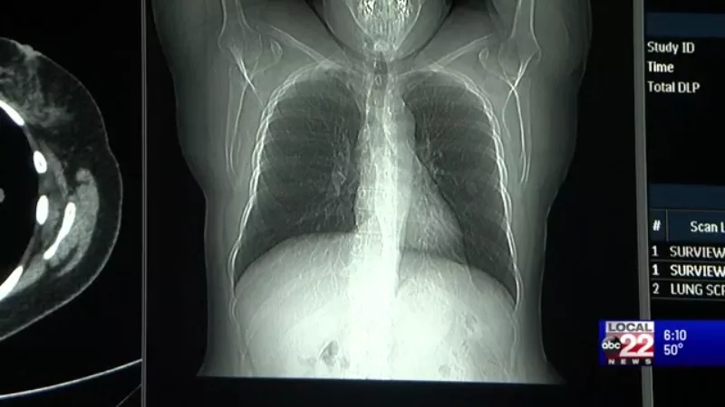 lung-cancer-screening274458