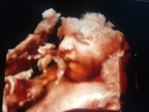 gary-b-ultrasound-1