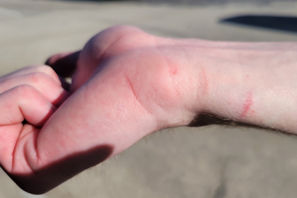 dunkinbruises
