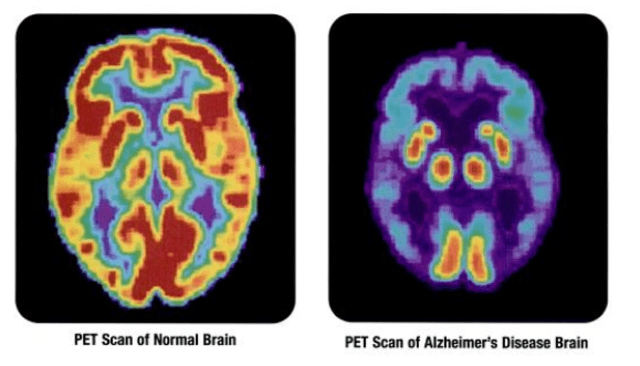 640px-pet_scan-normal_brain-alzheimers_disease_brain-png-2