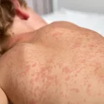 New CDC report warns that measles elimination in the U.S. is under ‘renewed threat’