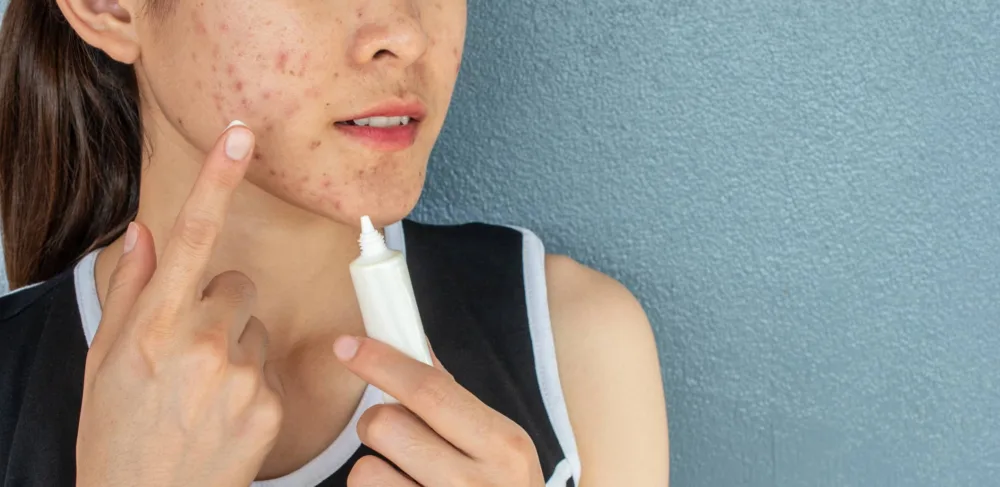 portrait-of-woman-with-acne-inflammation-papule-and-pustule-on-her-face-and-she-trying-to-applying-acne-cream-on-her-face-for-treat