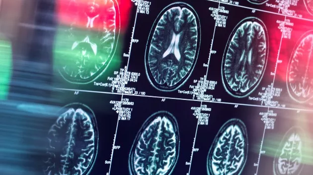 gettyrf_41423_brainscan2028129135627