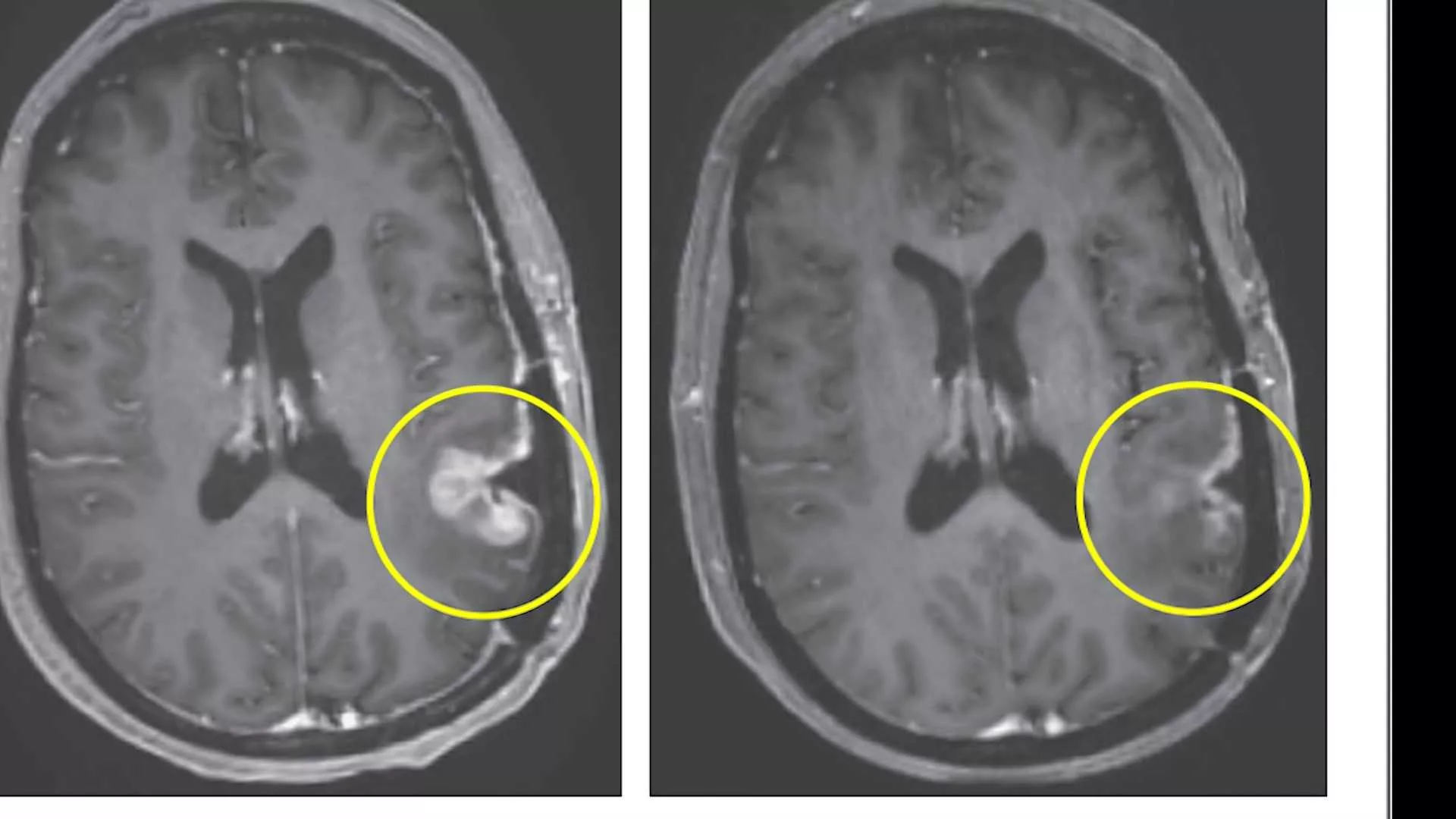 massachusetts-clinical-trial-shows-dramatic-and-rapid-progress-against-glioblastoma-tumors-65f213c0ab4f7422138