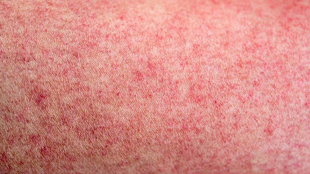 measles-jpeg-2